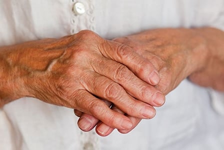 Rheumatoid Arthritis and Osteoarthritis
