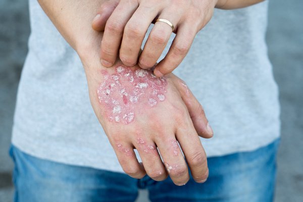 How to Get Rid of Psoriasis | If you're looking for more information about the types of psoriasis, symptoms, treatment options, and natural remedies to help treat and prevent a flare-up, this post is a great place to start. Whether you have psoriasis on your scalp, hands, feet, or face, or it affects larger parts of your skin, we're sharing natural treatments to calm your skin and relieve pain and redness! #psoriasis #psoriasistreatment #psoriasisremedies